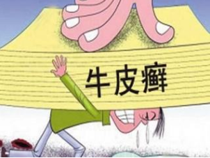 治疗牛皮癣